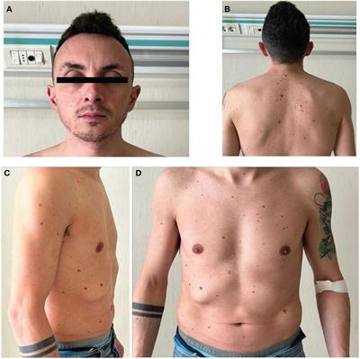 Gonadal dysfunction in a man with Noonan syndrome from the LZTR1 variant: case report and review of literature